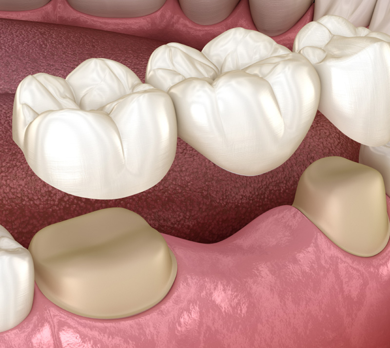 Dental-Bridges-2 Dr. Peter Servinis