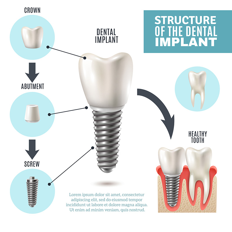 Dental-Implant Dr. Peter Servinis