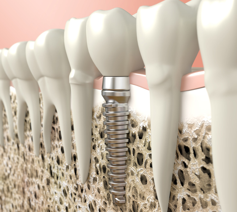 Dental-Implants-1 Dr. Peter Servinis