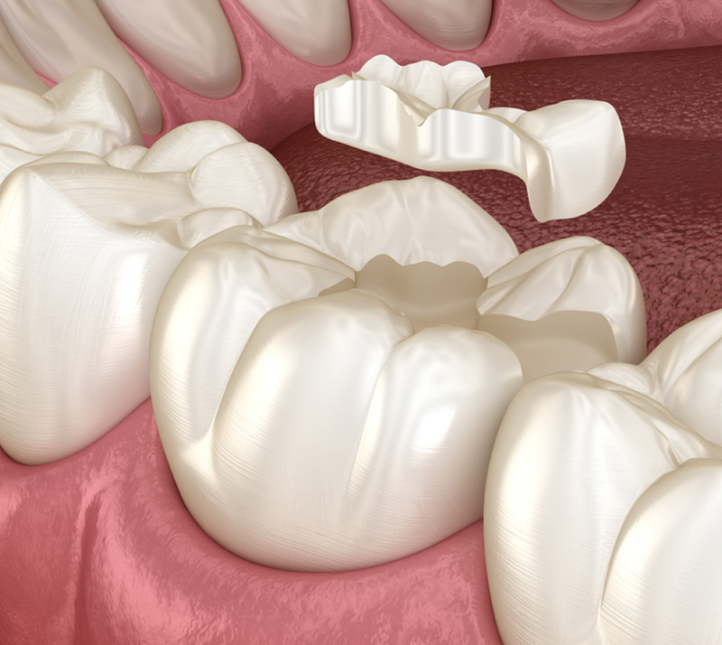 Inlays-&-Onlays-2 Dr. Peter Servinis