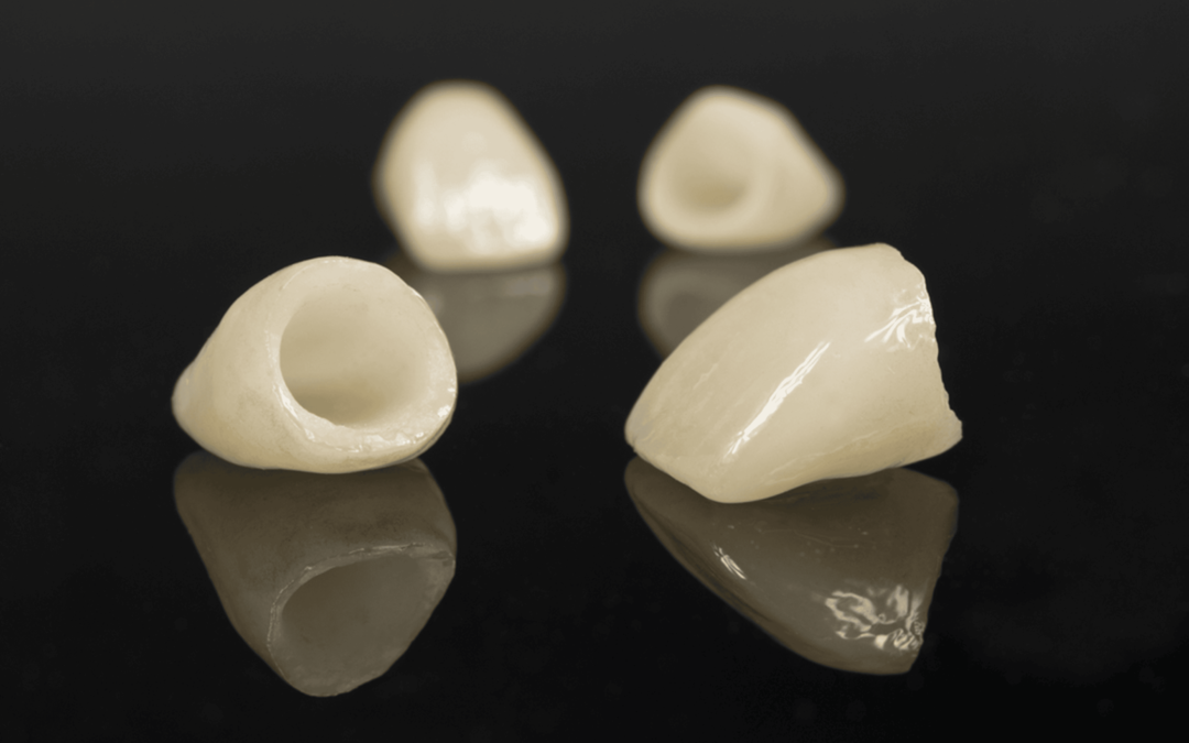 3 Key Signs Your Dental Crown Needs Replacement or Refitting