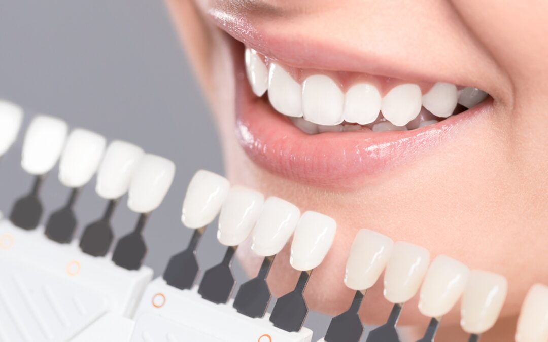 4 Common Questions About Dental / Porcelain Veneers